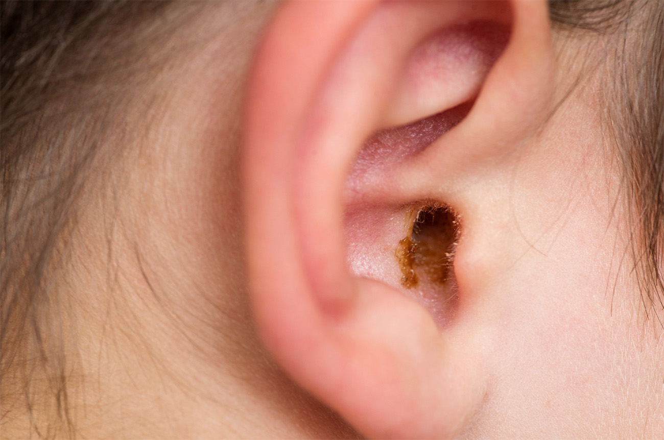 Understanding the Importance of Removing Ear Wax